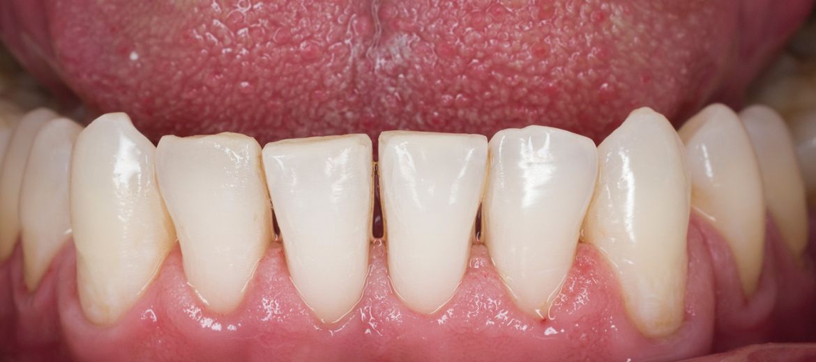 Hygiene Appointment  -  Guided Biofilm Therapy